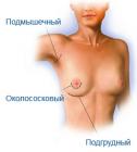 Прикрепленное изображение: Маммопластика.jpg